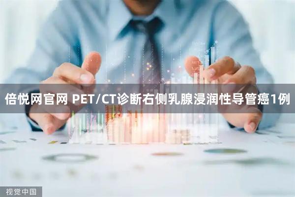 倍悦网官网 PET/CT诊断右侧乳腺浸润性导管癌1例